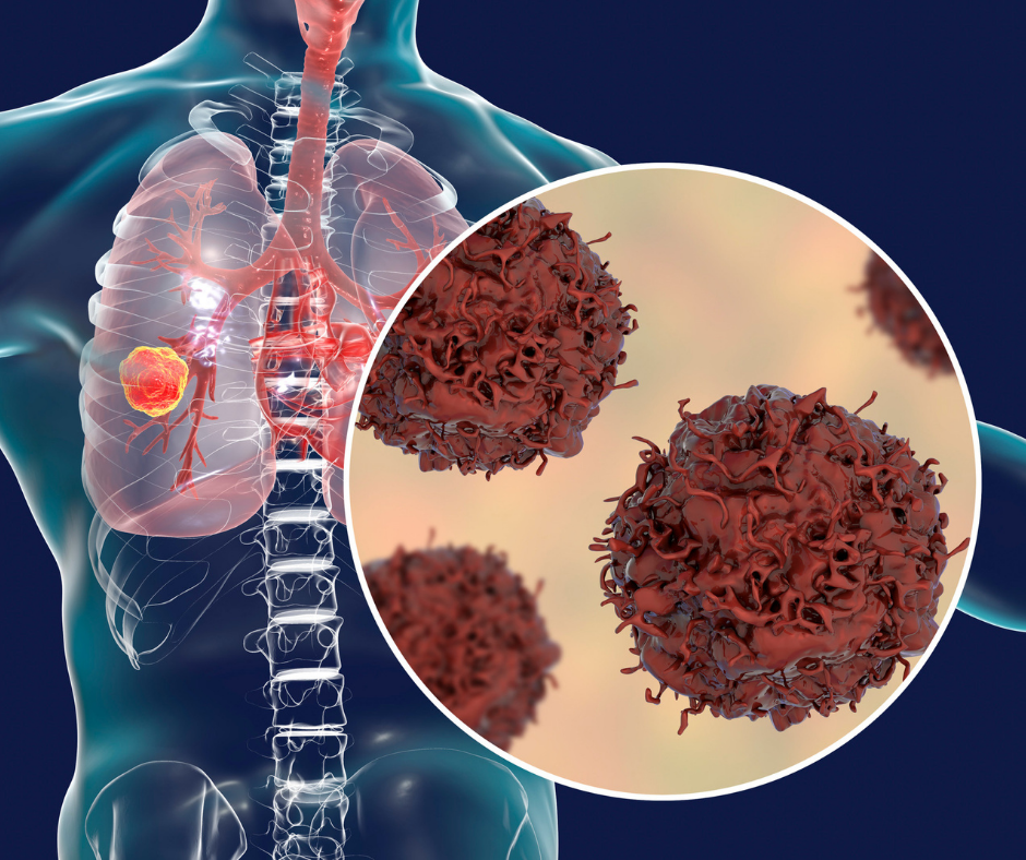 Interstitial lung disease (ILD)